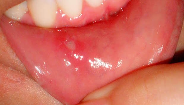 विटामिन ‘बी’ कॉम्पलेक्स के कमी से मुँह में छाले