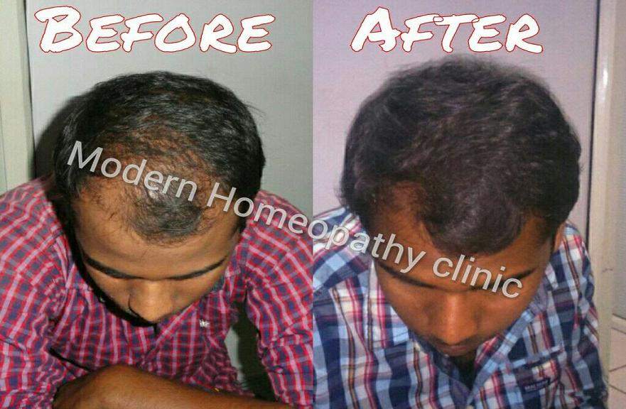 Is Hair Regrowth Possible With Homeopathy Medicines