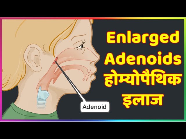 Homeopathic Treatment For Enlarged Adenoids