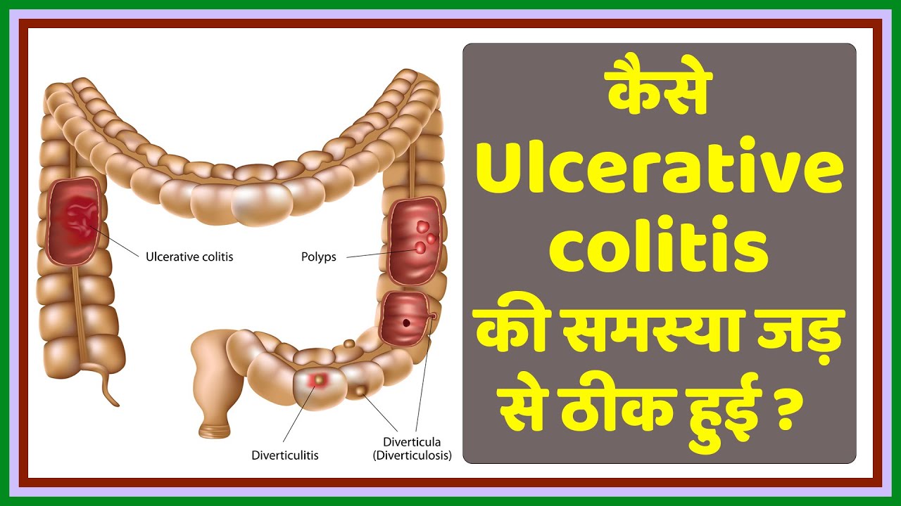 Homeopathic Medicine For Ulcerative Colitis