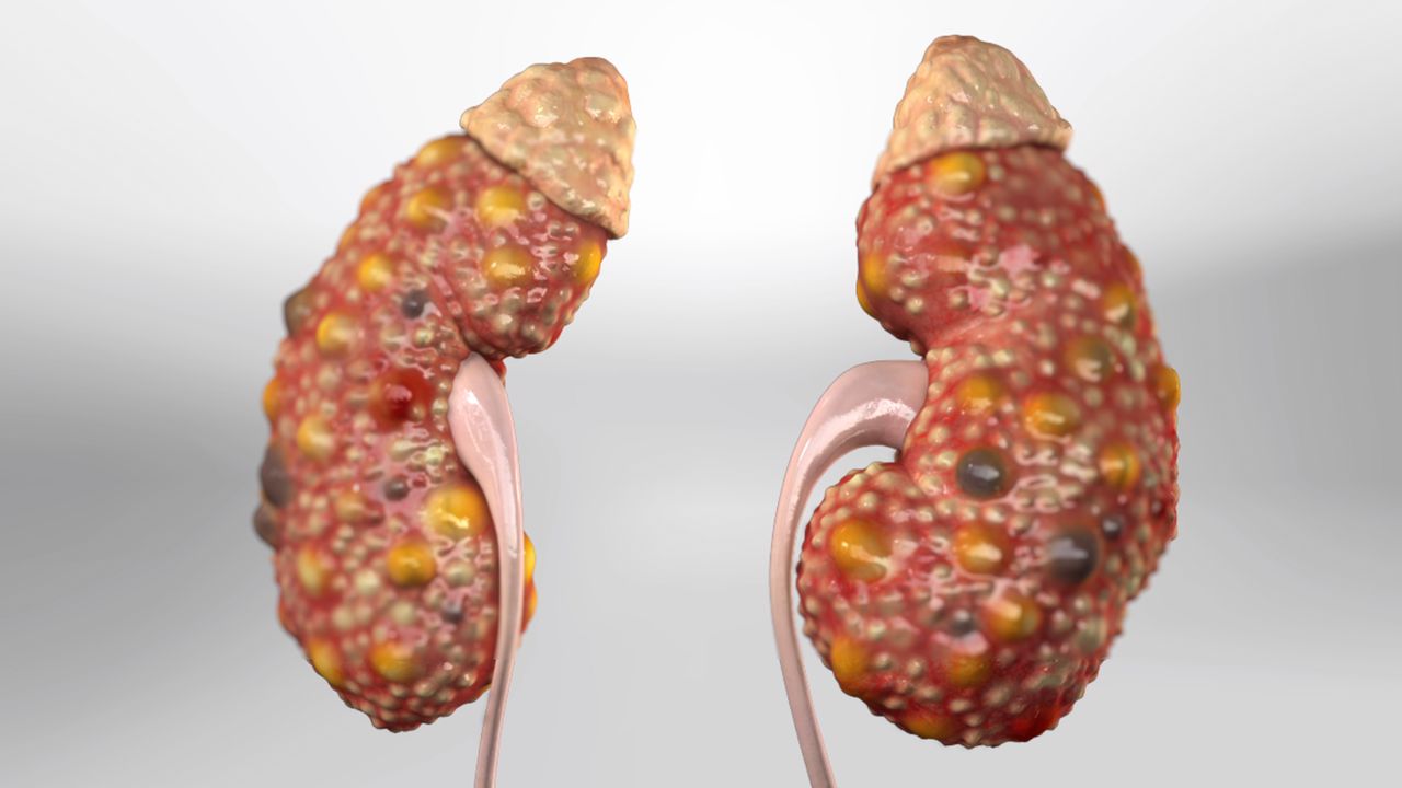 Polycystic Kidney Homeopathic Treatment In Hindi